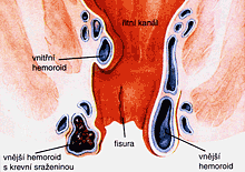 hemeroidy