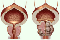 Prostata