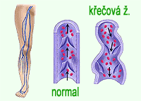 křečová žíla